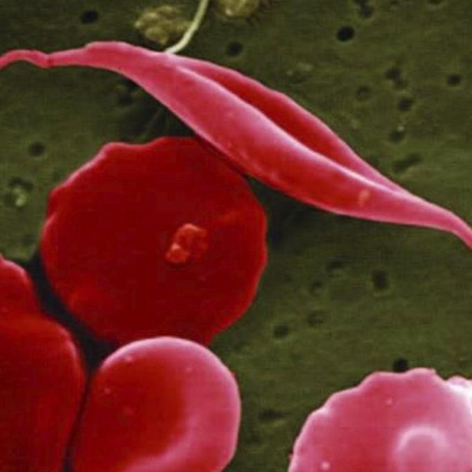 Promising new gene therapies for sickle cell are out of reach in countries where they're needed most